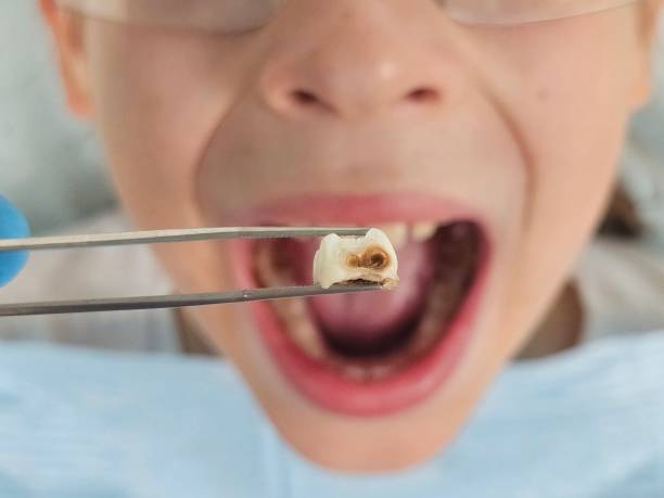 Best Dental Abscess Treatment in Grapeland, TX