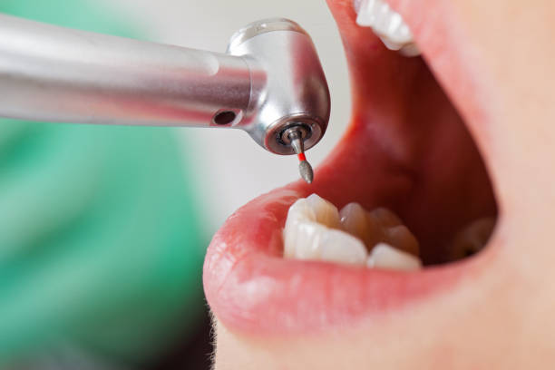 Best Broken or Chipped Tooth Repair in Grapeland, TX